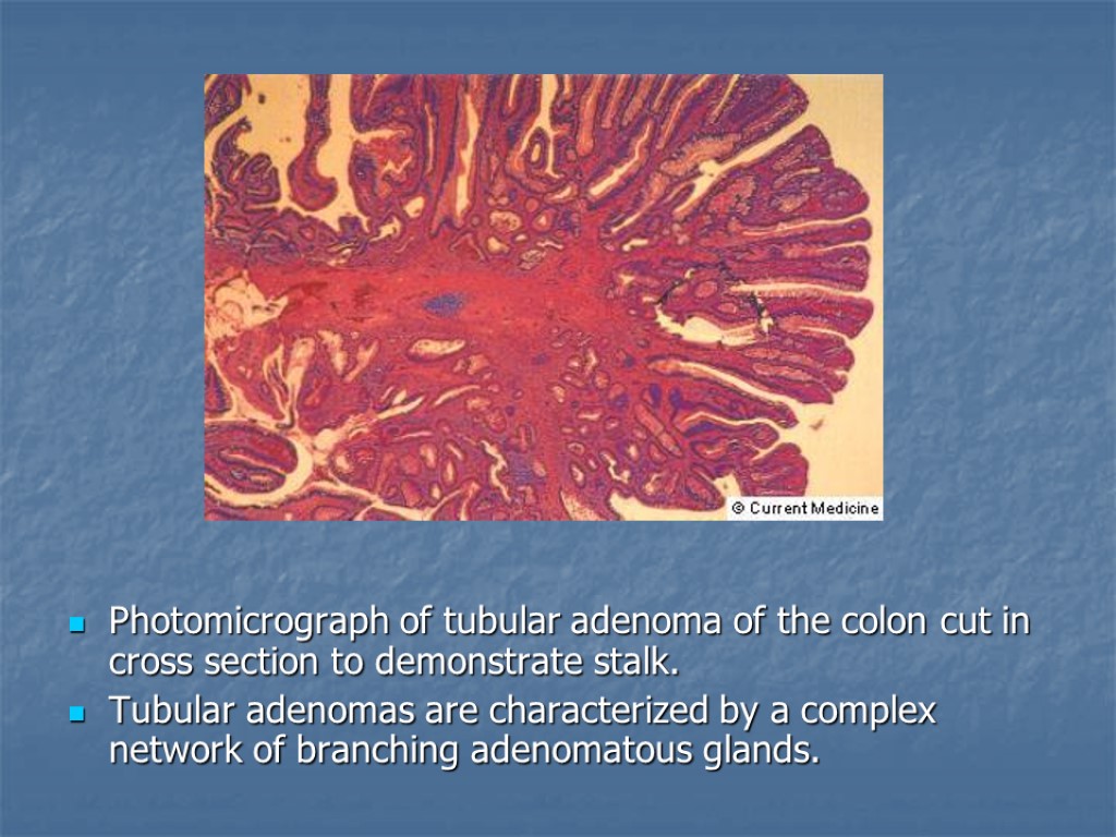 Photomicrograph of tubular adenoma of the colon cut in cross section to demonstrate stalk.